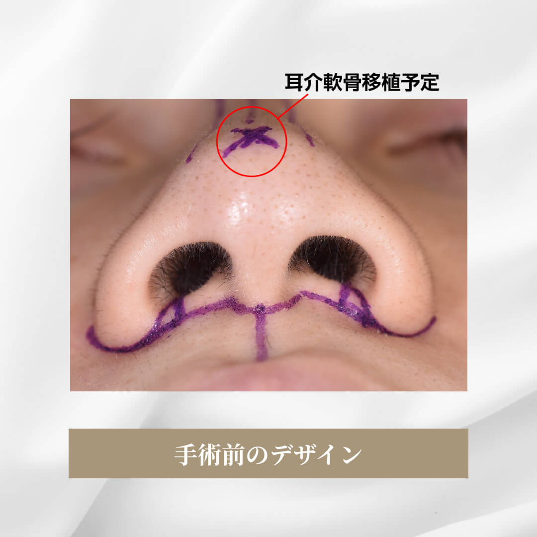 鼻尖軟骨形成の症例