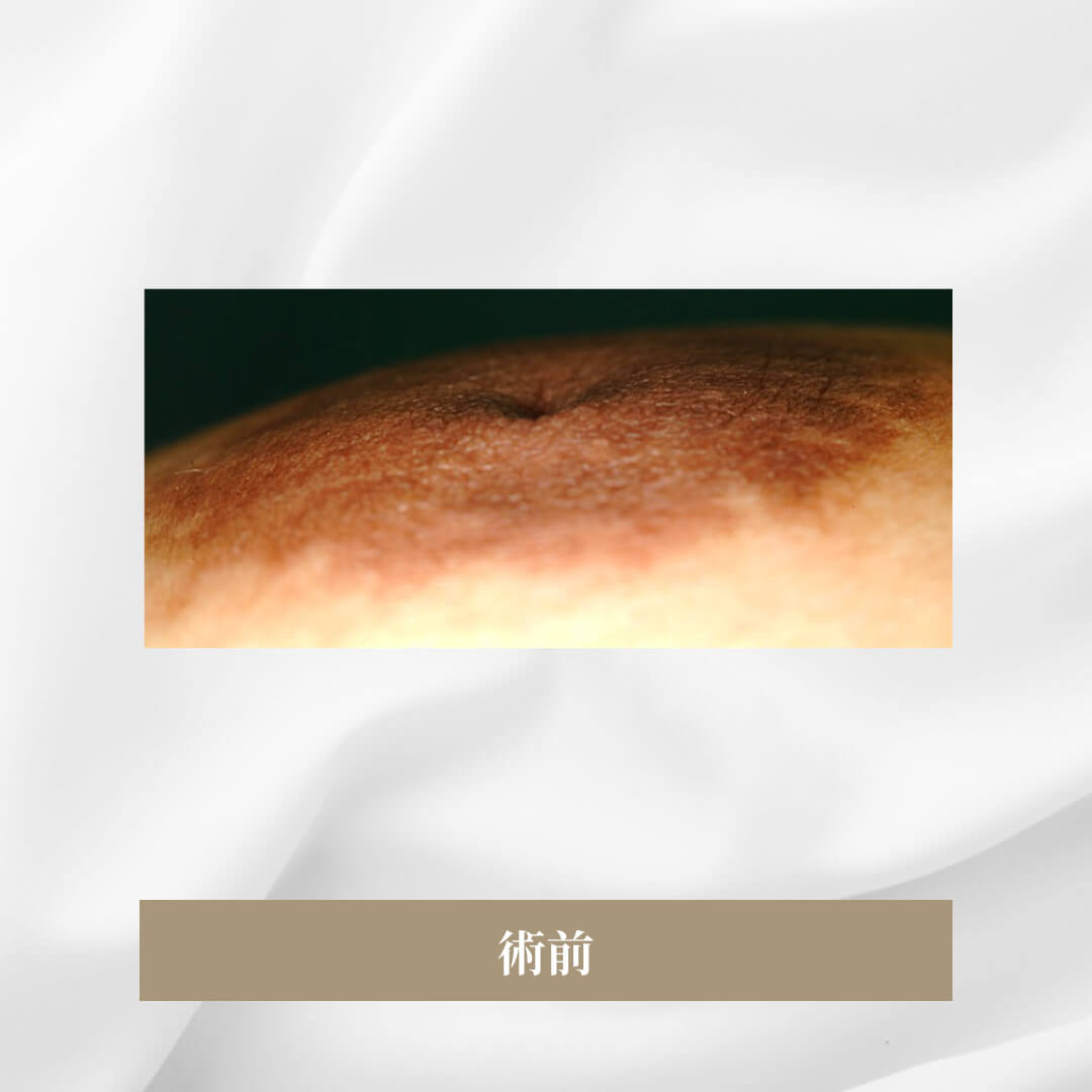 先天的な陥没乳頭