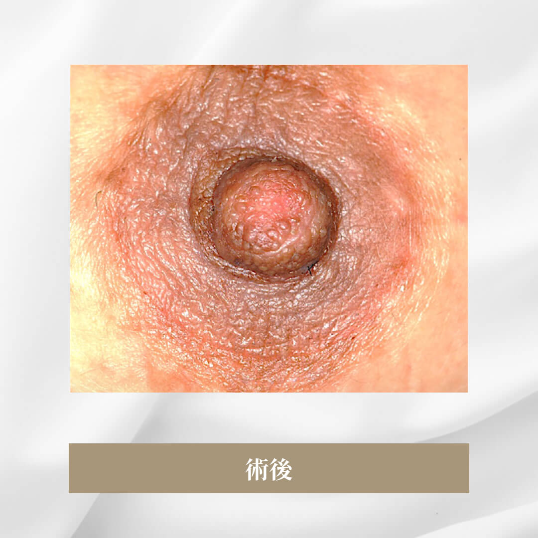 先天的な陥没乳頭