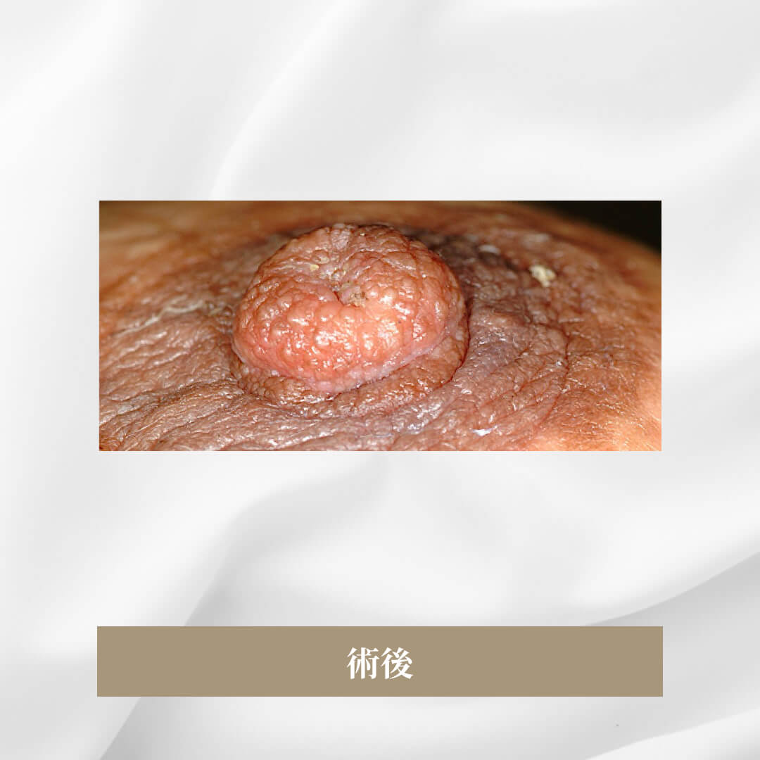 先天的な陥没乳頭