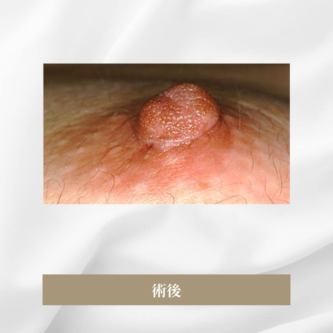 乳房が成長するにしたがって陥没した乳頭になった