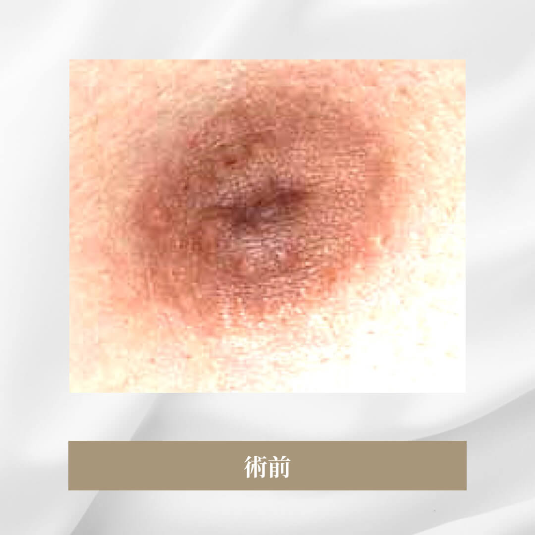 乳母の発育にしたがって乳頭が陥没