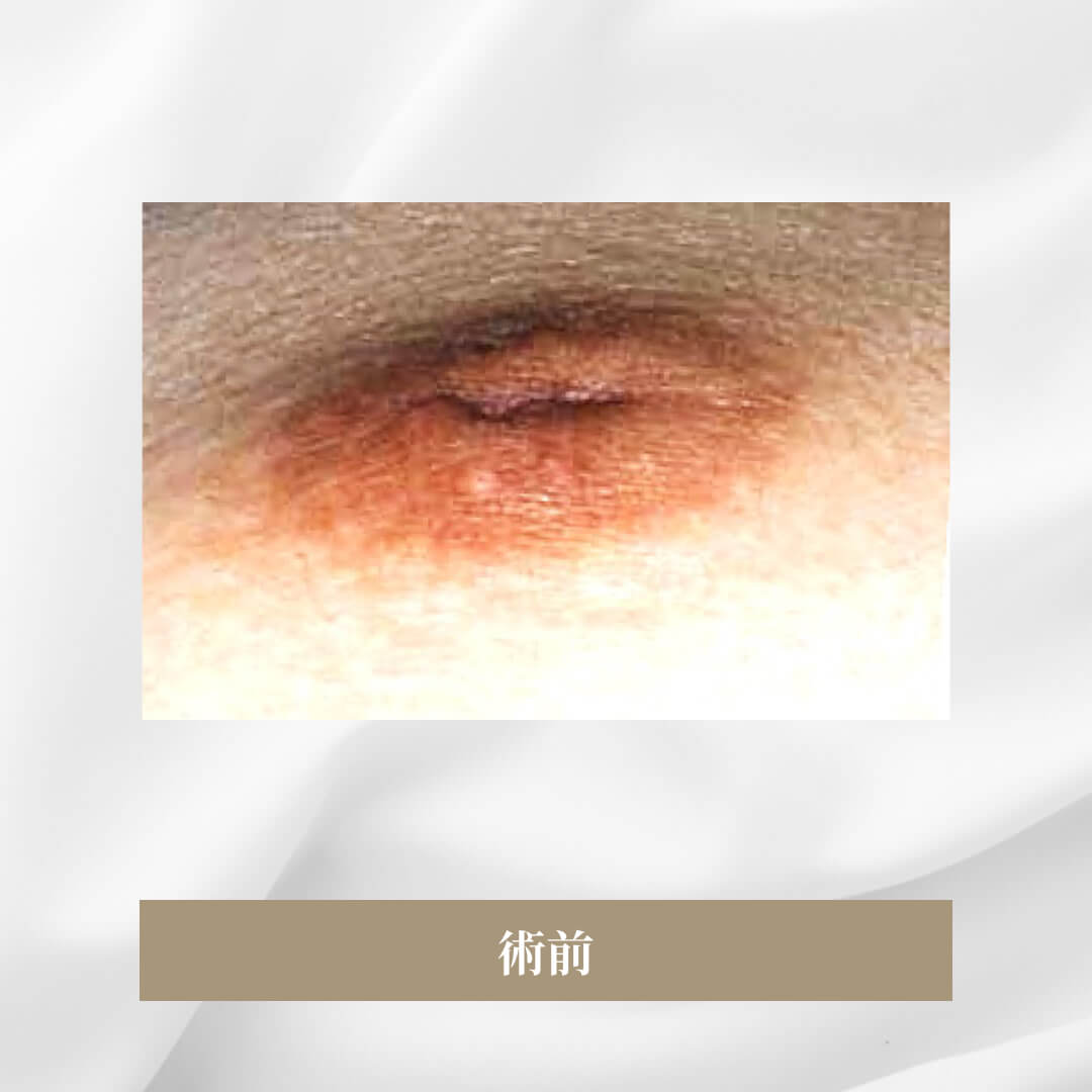 乳母の発育にしたがって乳頭が陥没