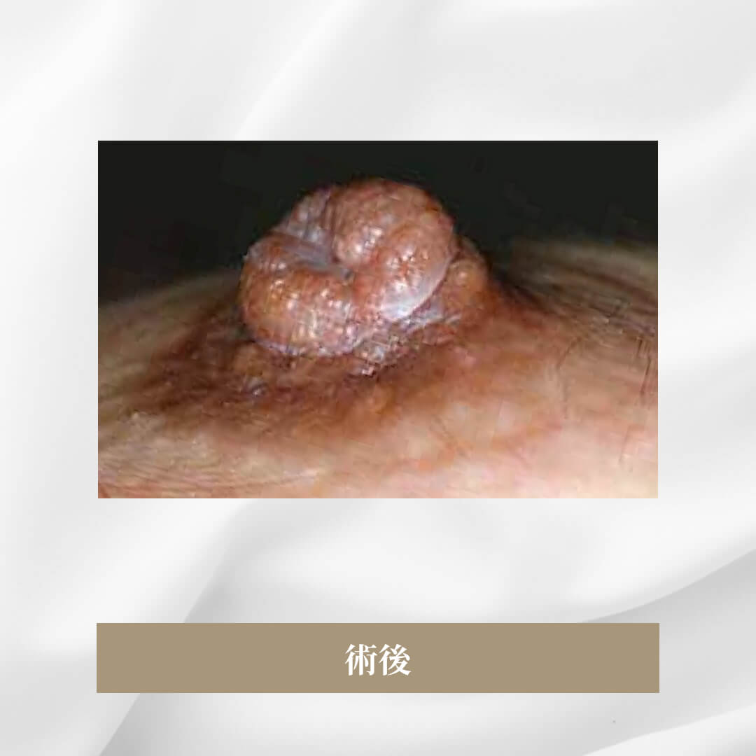 乳母の発育にしたがって乳頭が陥没