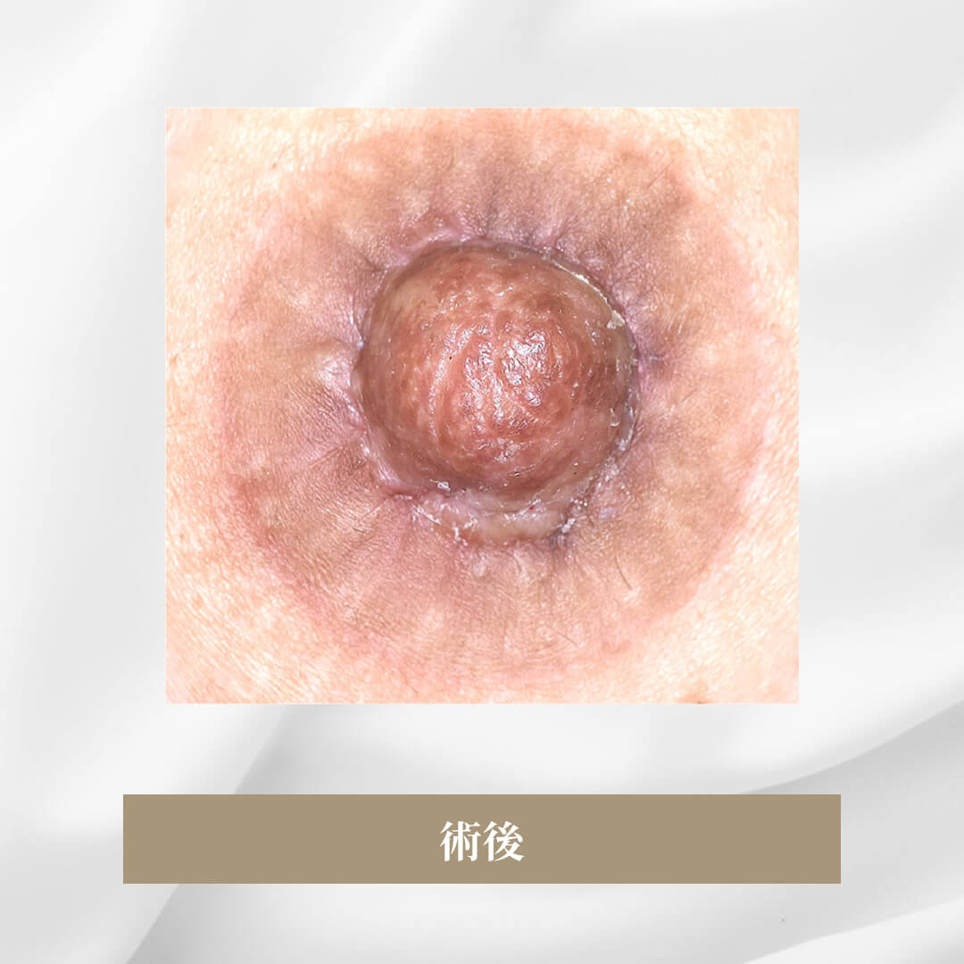 他院で2回手術治療をしたが、良い結果が得られなかった