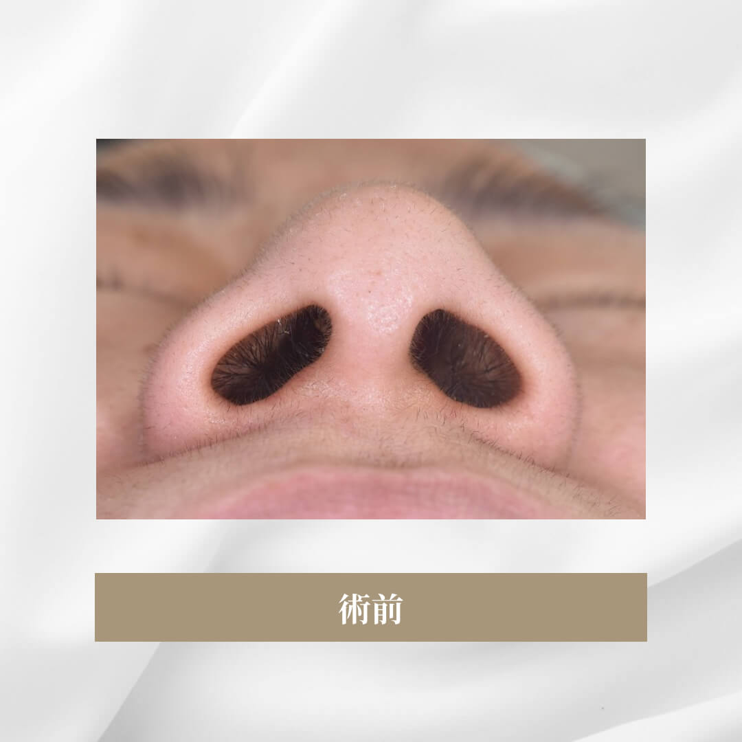 鼻翼形成(小鼻縮小)の症例