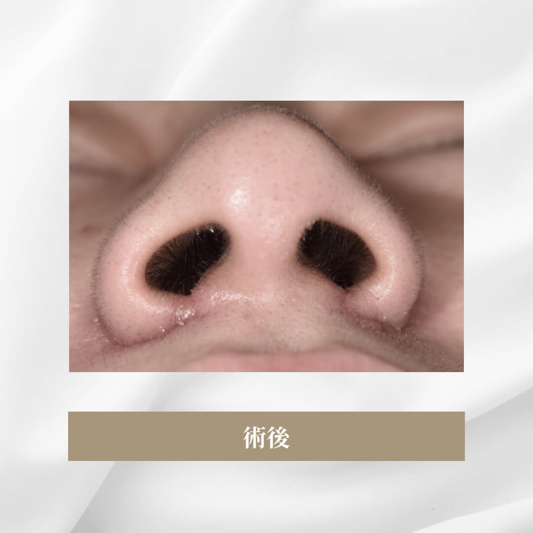 鼻翼形成(小鼻縮小)の症例