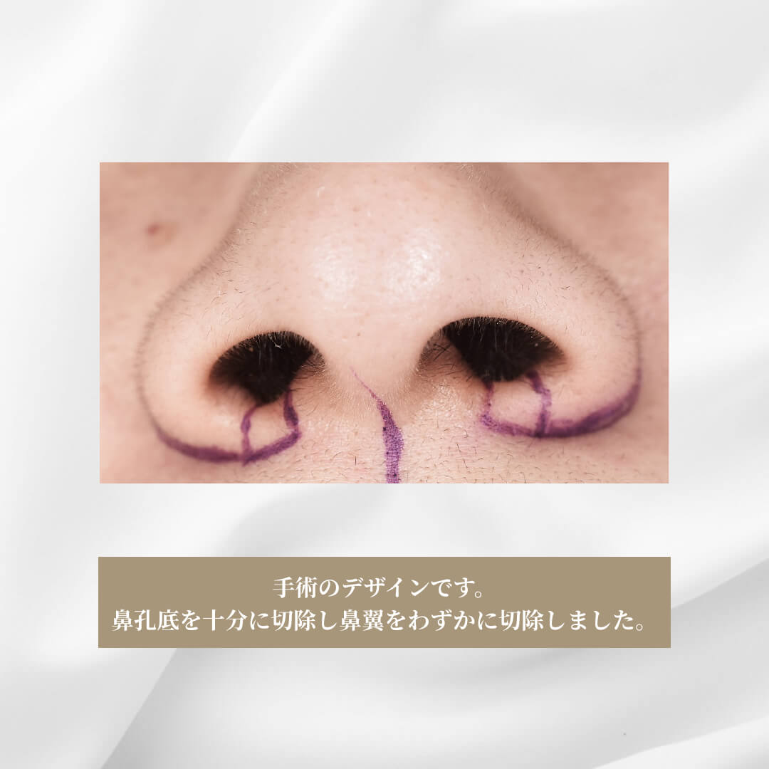 鼻翼形成(小鼻縮小)の症例