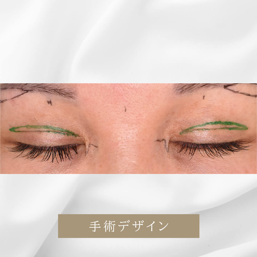加齢による眼瞼のたるみの修正と瞳を大きくしたい