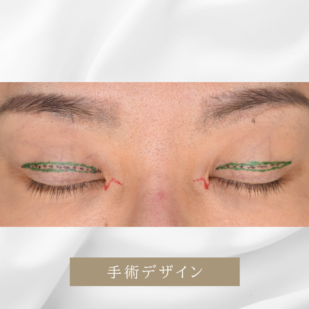 目頭の蒙古ひだを小量広げ、目元を大きくすっきりしたい