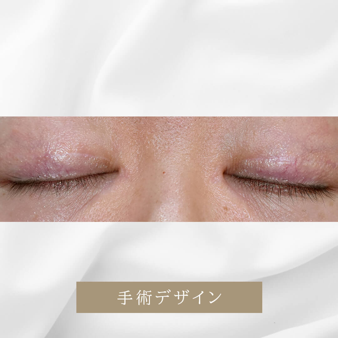 著しい蒙古ひだの修正