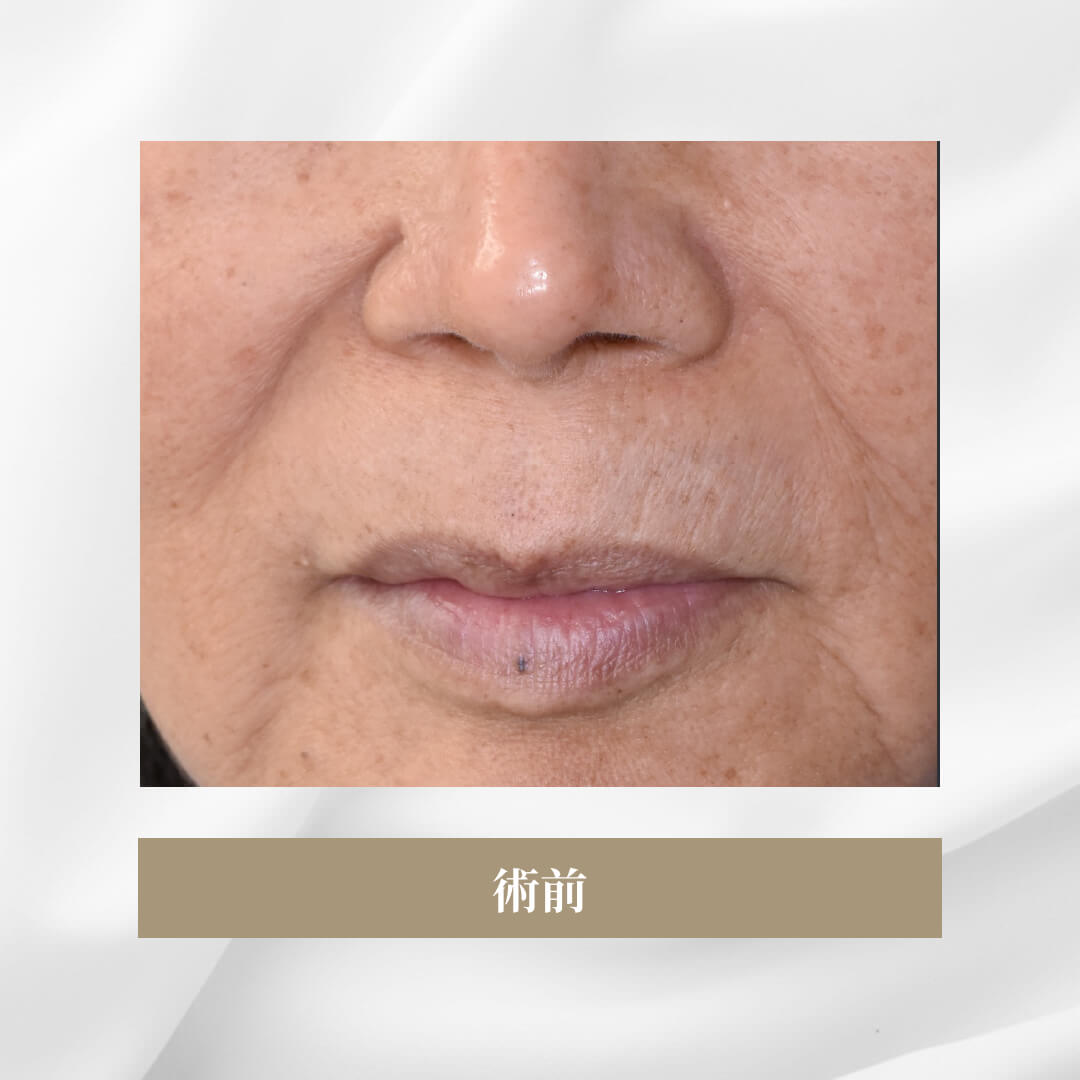 加齢により鼻の下が伸び、上口唇が薄くなった