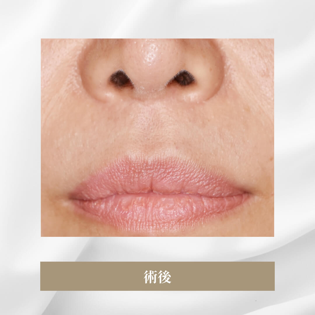 皮膚を極めて小量の切除での鼻の下の短縮