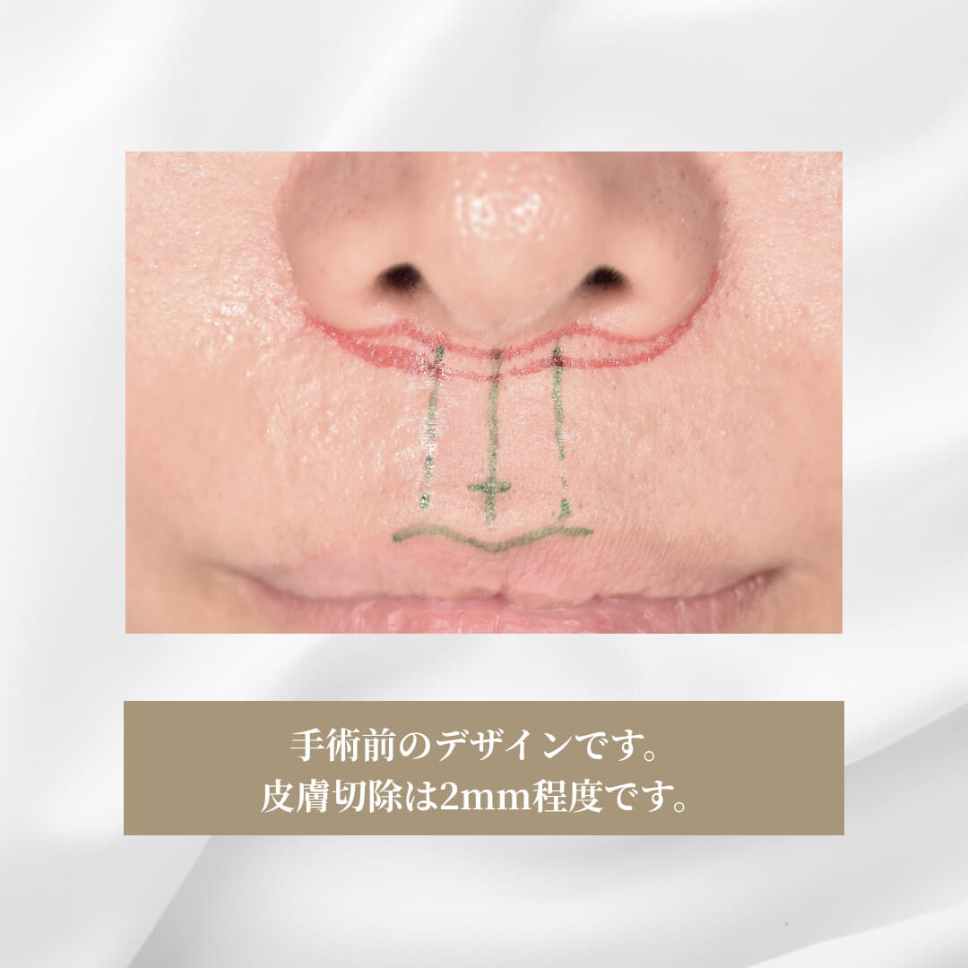皮膚を極めて小量の切除での鼻の下の短縮