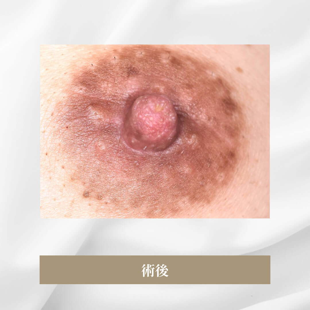授乳により乳頭が長く変形してしまった
