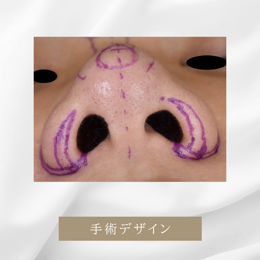 プロテーゼと耳介軟骨による隆鼻術の症例