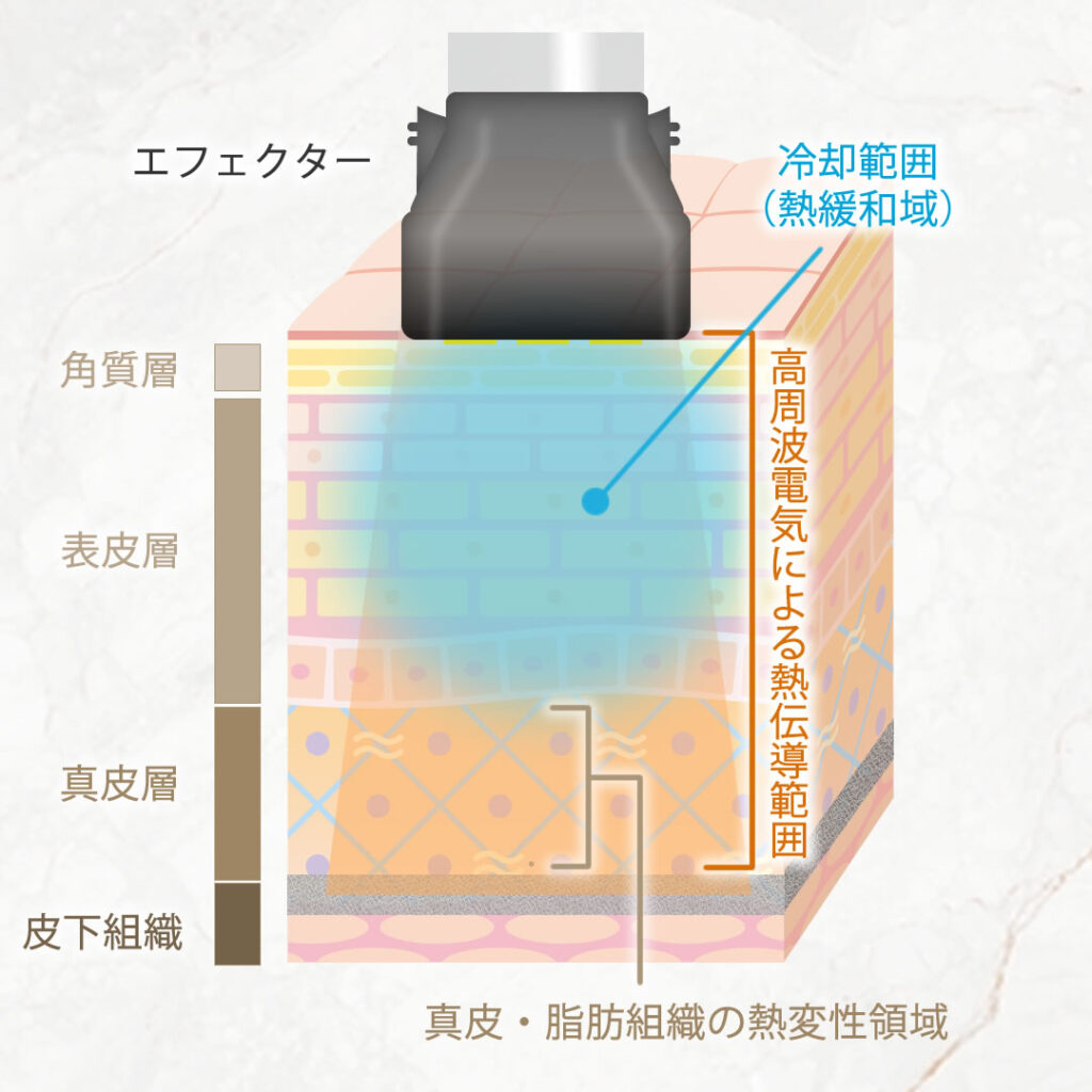 ザーフの高周波の図解