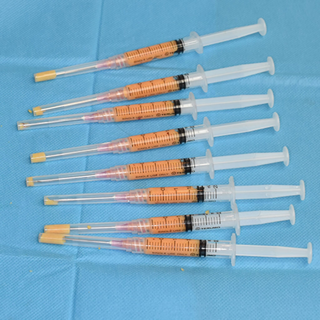 含有脂肪細胞混和細胞を注入用注射器に分包しているイメージ