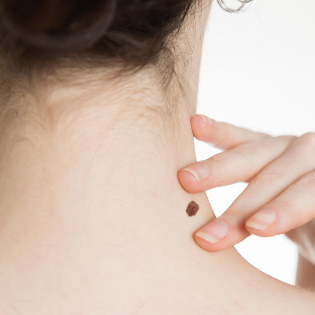首にあるほくろのイメージ