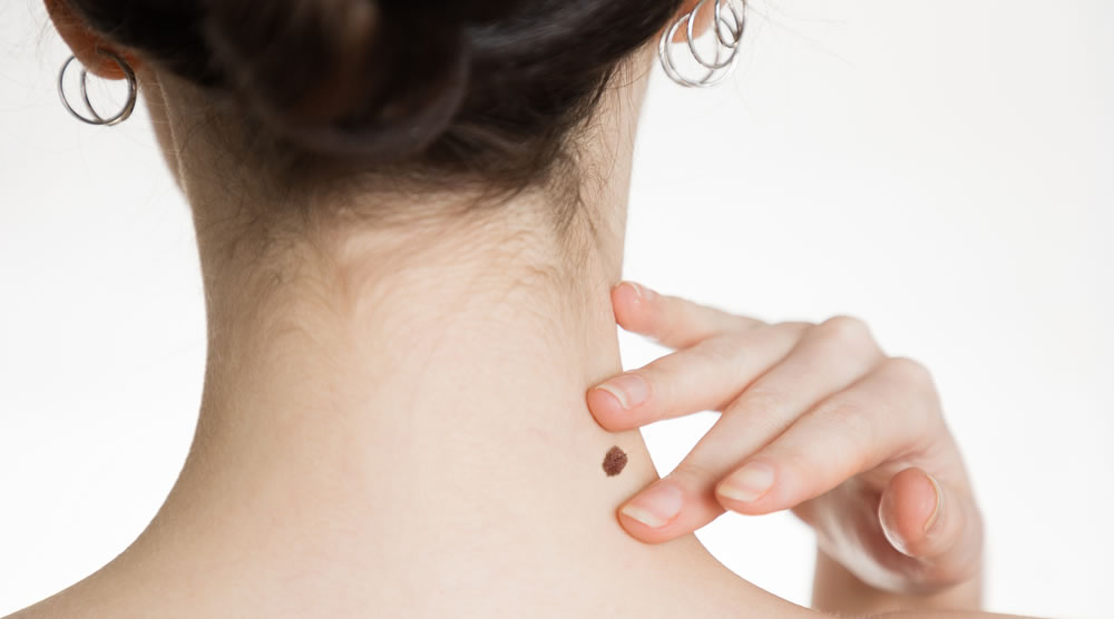 ほくろが気になる女性